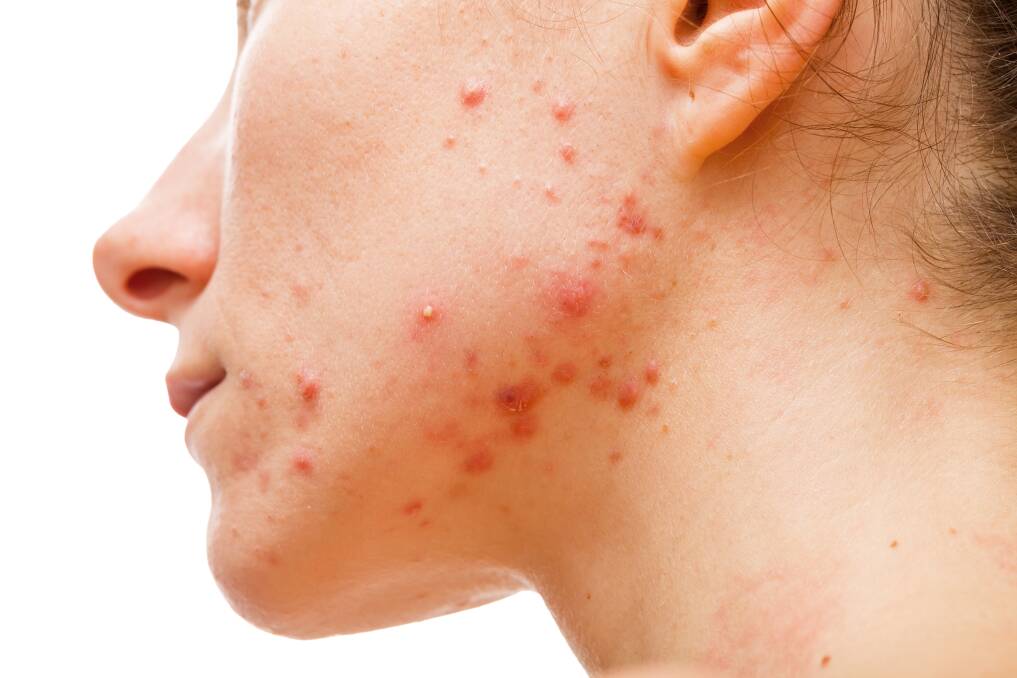 HELP IS HERE: Talk to your skin specialist for the best products for your specific skin type and consume a diet high in antioxidants to improve acne and troubled skin.