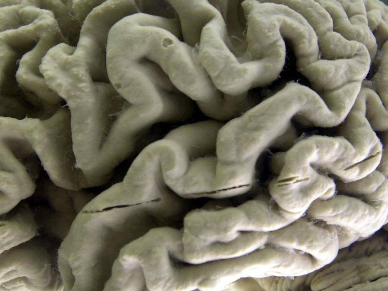 Fibronectin is a lining that exists in larger quantities in people with Alzheimer's disease. (AP PHOTO)